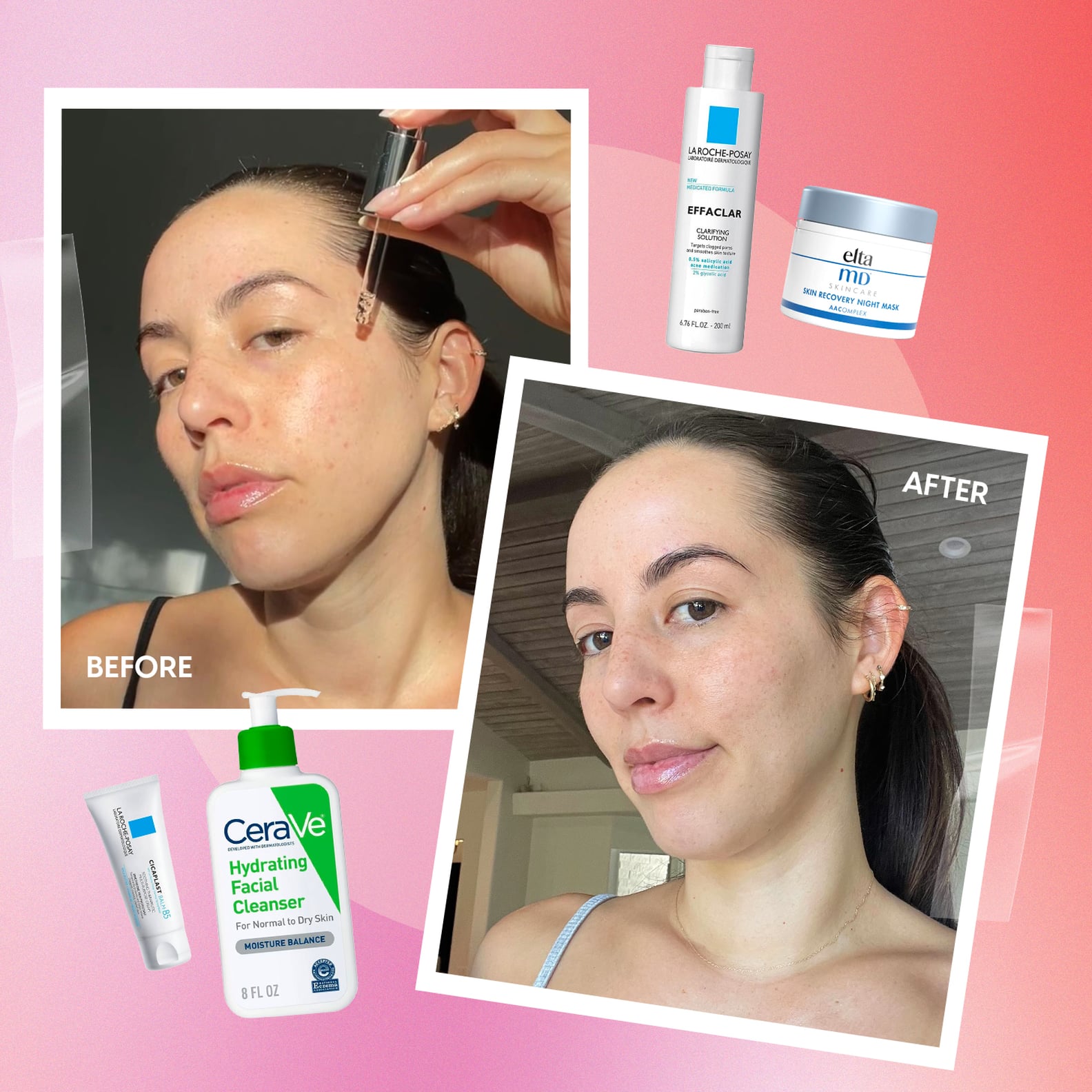 i-tried-skin-cycling-on-acne-prone-skin-see-photos-popsugar-beauty