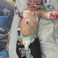 Every Parent Needs to See What Meningitis Did to This Toddler