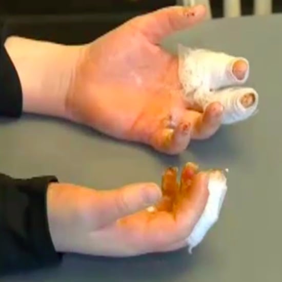 Third-Degree Burns From Slime