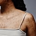 Body Acne Causes and Treatments, According to Dermatologists