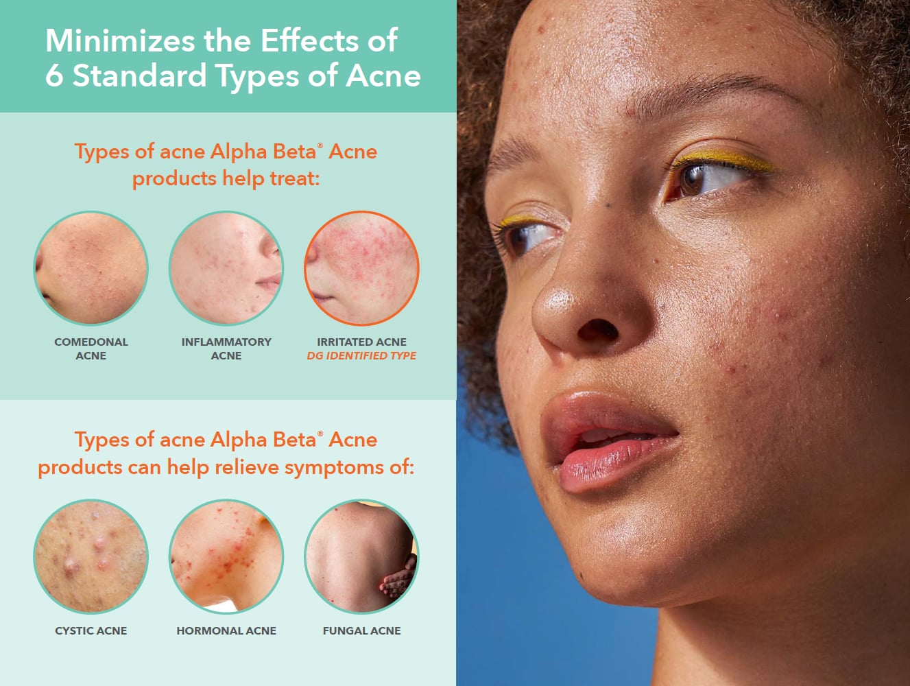 Dr. Dennis Gross Skincare Acne Line different types of acne.