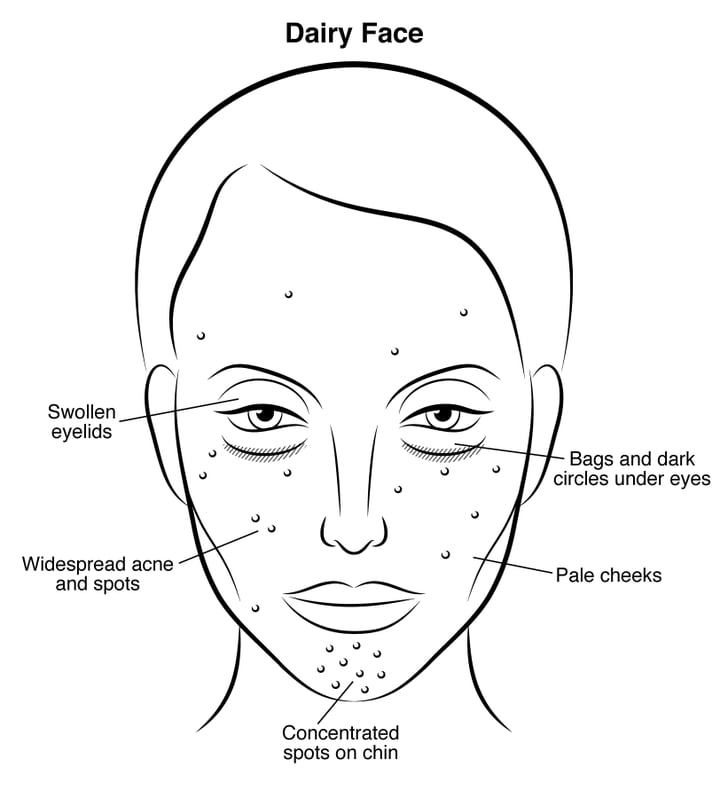Dairy Face Gut Health And Skin Problems POPSUGAR Beauty Photo 2