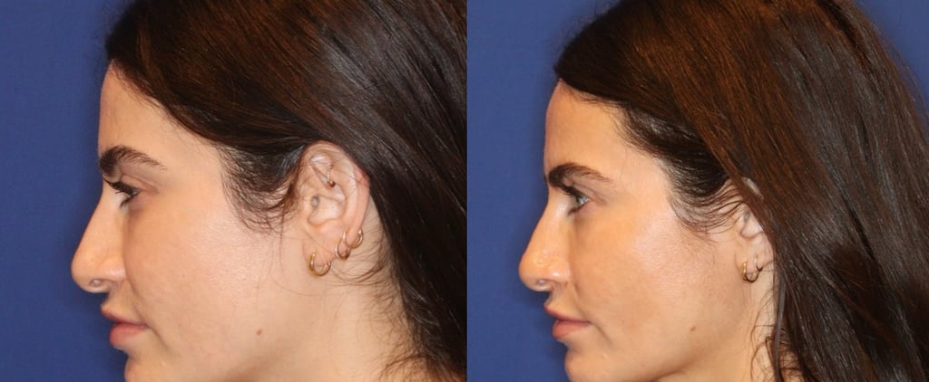 Ultherapy Before and After: Read This Editor's Full Review