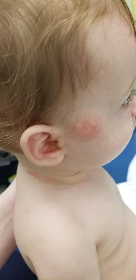 Mom's Warning on Pacifiers After Son Gets Burned