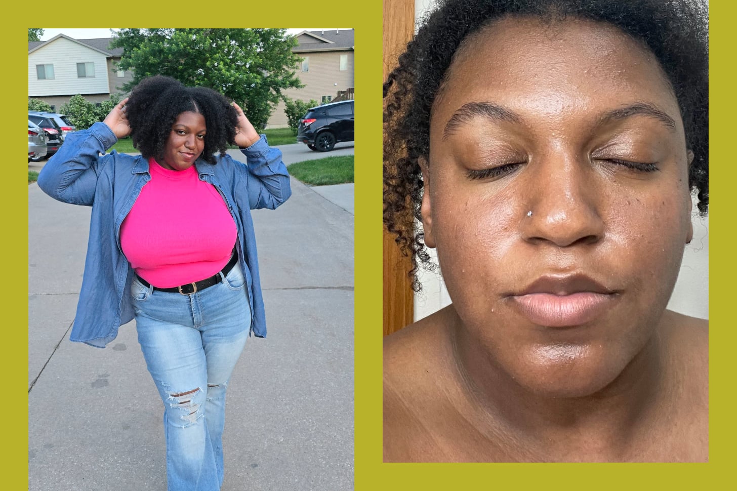 Two photo of Emmeka Hawkins, a young Black woman with chronic spontaneous urticaria. 
