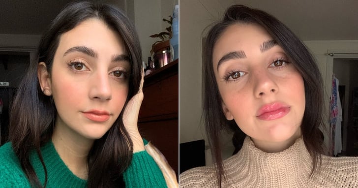 lip injections before and after