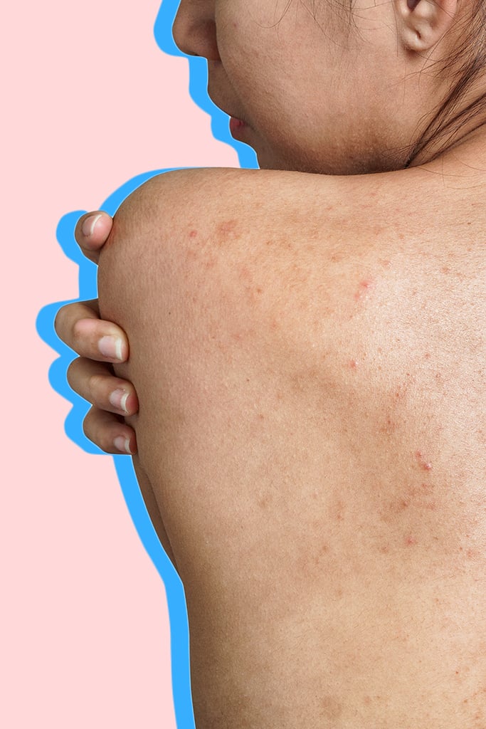 How To Get Rid Of Acne Scars According To Dermatologists Popsugar Beauty 2808