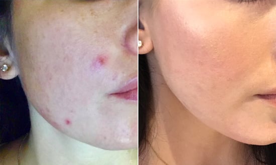 Best acne treatment uk top