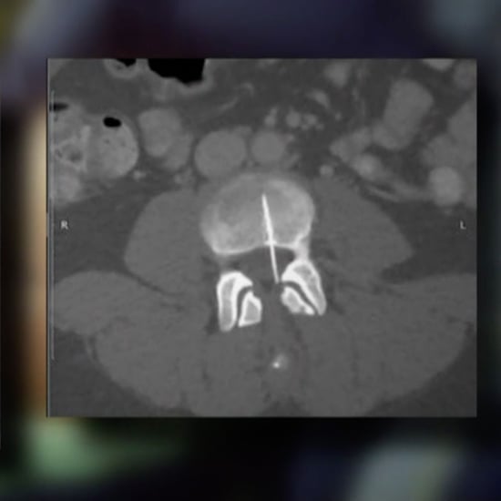 Epidural Needle Gets Stuck in Woman's Back