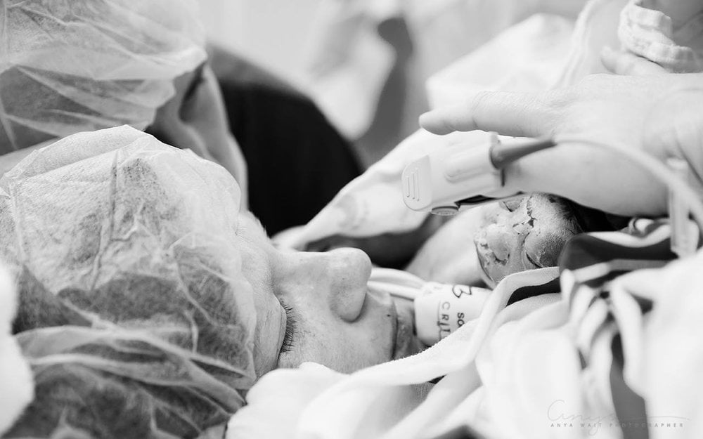C-Section Birth Photography