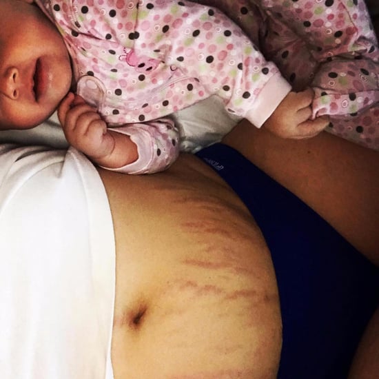 Mom Shares How She Came to Terms With Stretch Marks