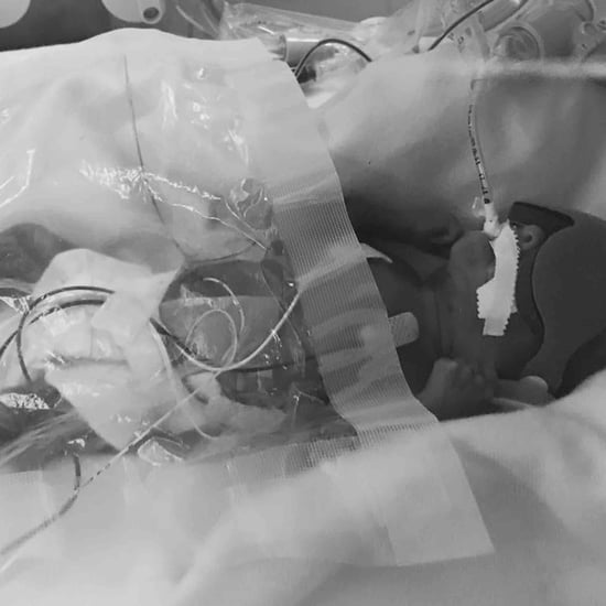 Preemie Baby Survives Birth Despite the Odds