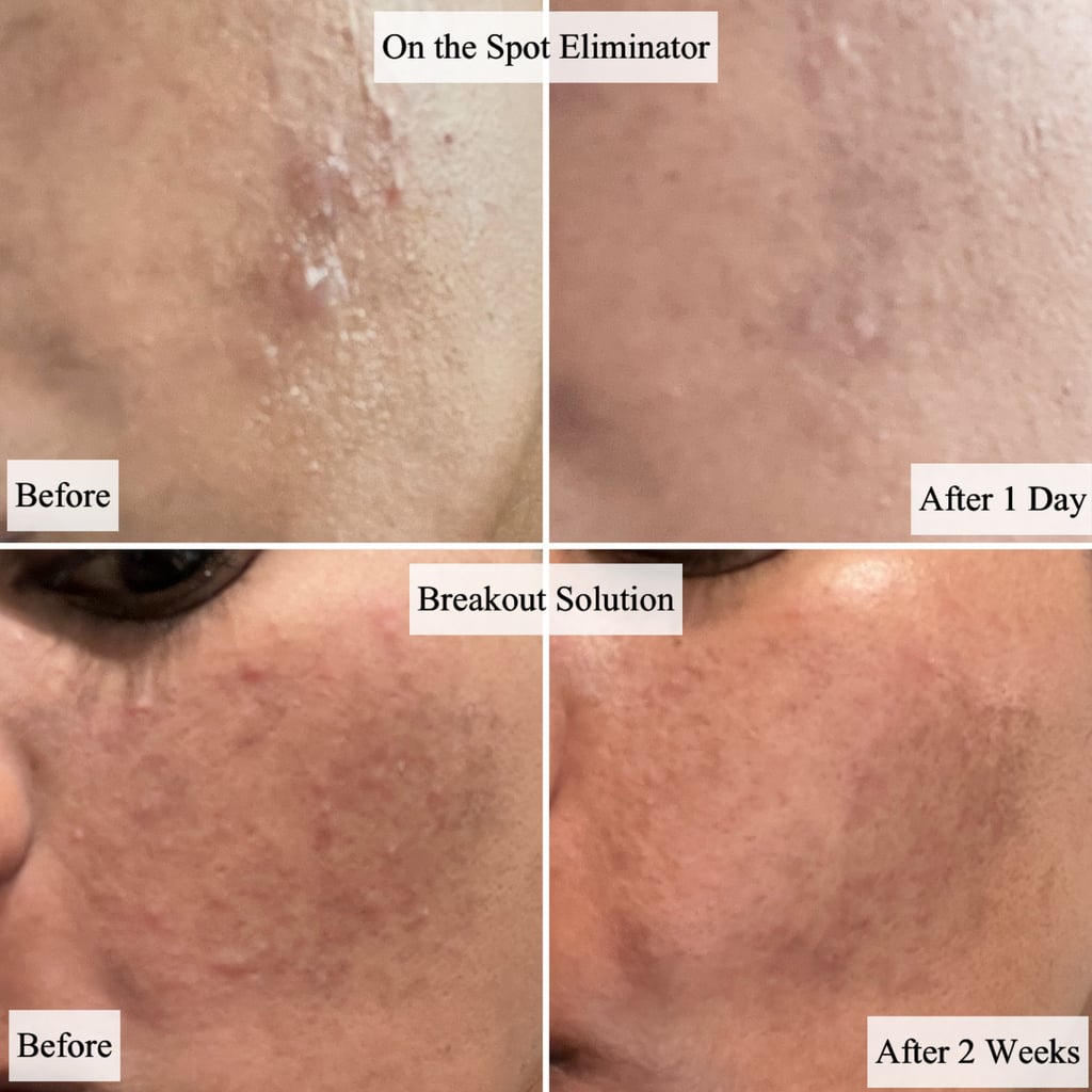Dr. Dennis Gross Skincare Breakout Solution and On The Spot Eliminator on Irritated Acne