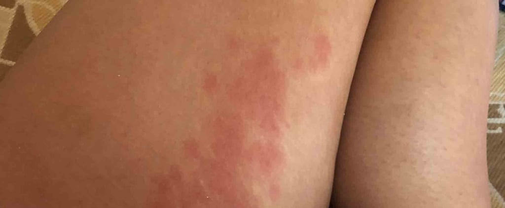 Chrissy Teigen Reveals Hives and Stretch Marks