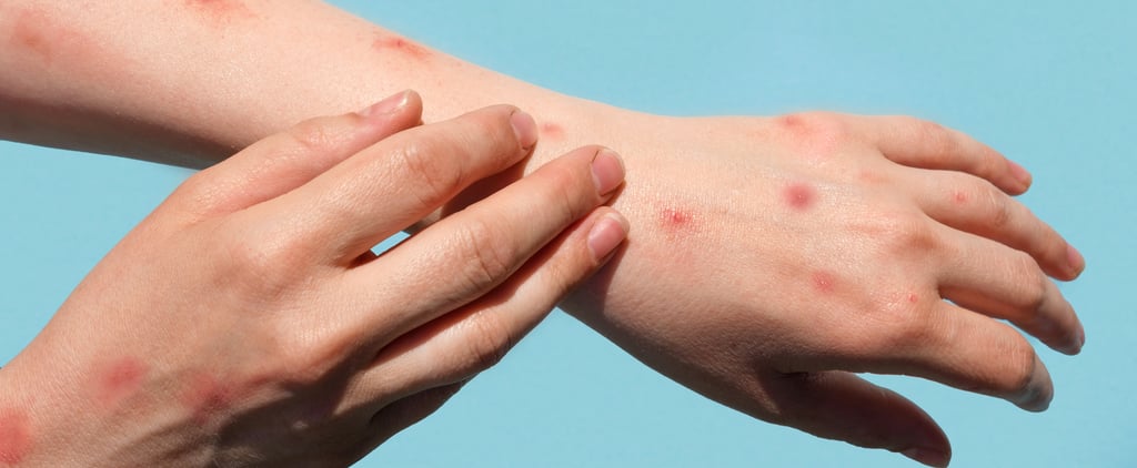 Is Monkeypox an STD? The Answer Is Complicated