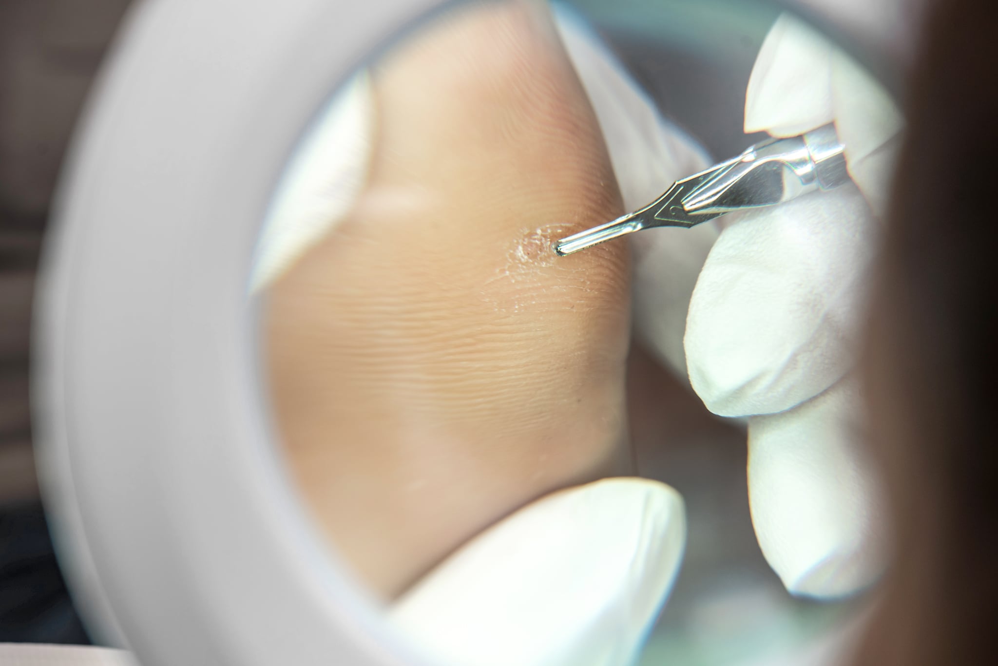 wart treatments, including wart treatments over the counter and natural wart treatments