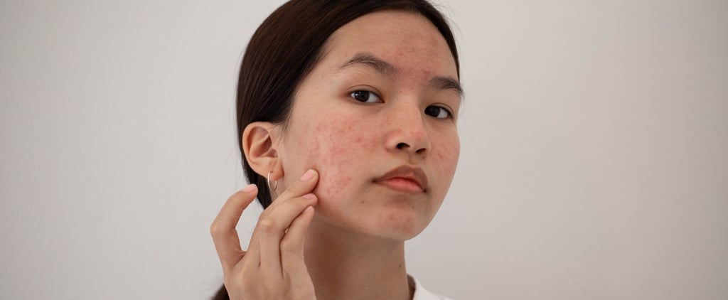 Stress Acne: Causes, Treatments, & More From Dermatologists