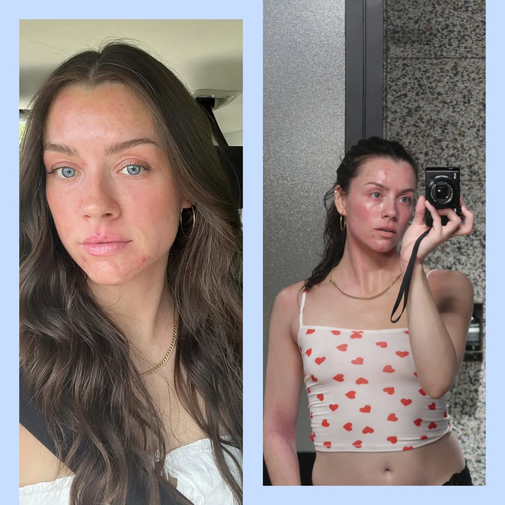 Skinfluencer Madeleine Edwards Doesn't Let Eczema Flare-Ups Run Her Life