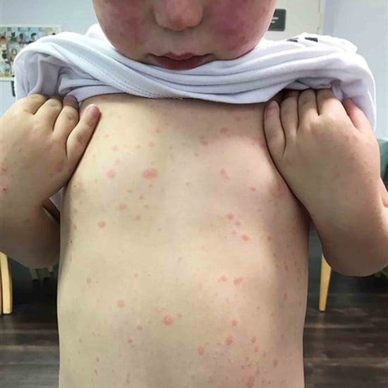 Mom Warns Parents About Rocky Mountain Spotted Fever