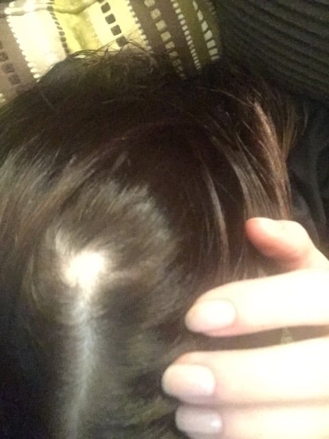 Here's a closeup of Sarah's alopecia areata, a small bald patch.