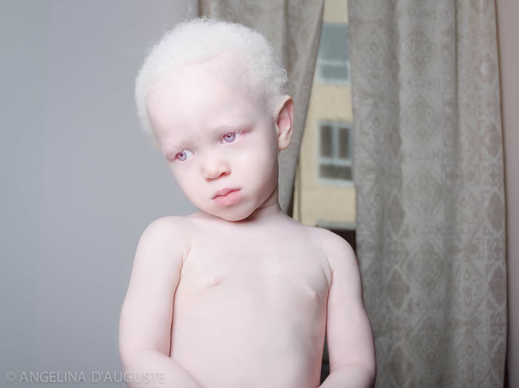 Albinism Photographs