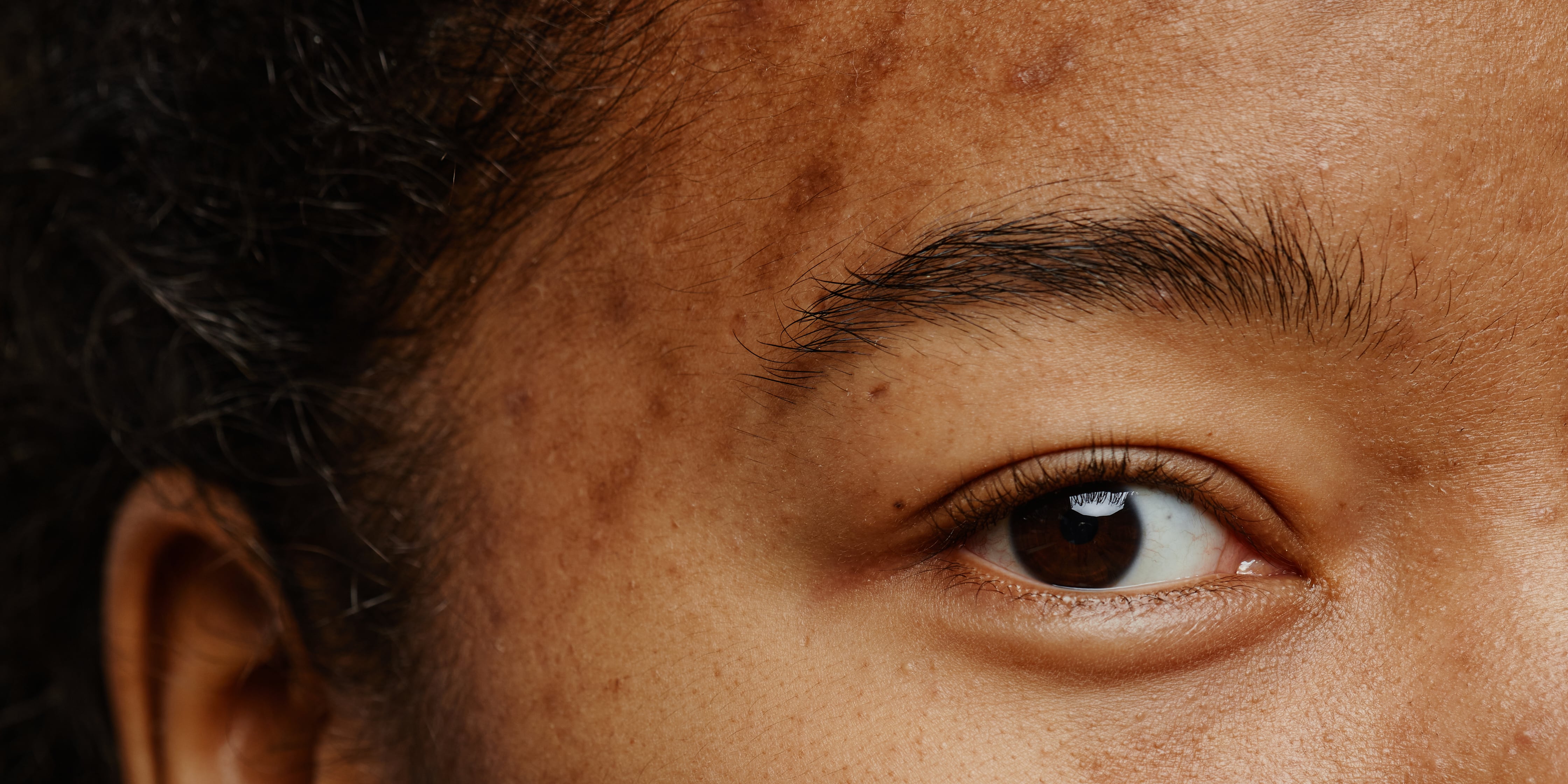 Acne and Vitamin Deficiencies What You Should Know POPSUGAR Beauty