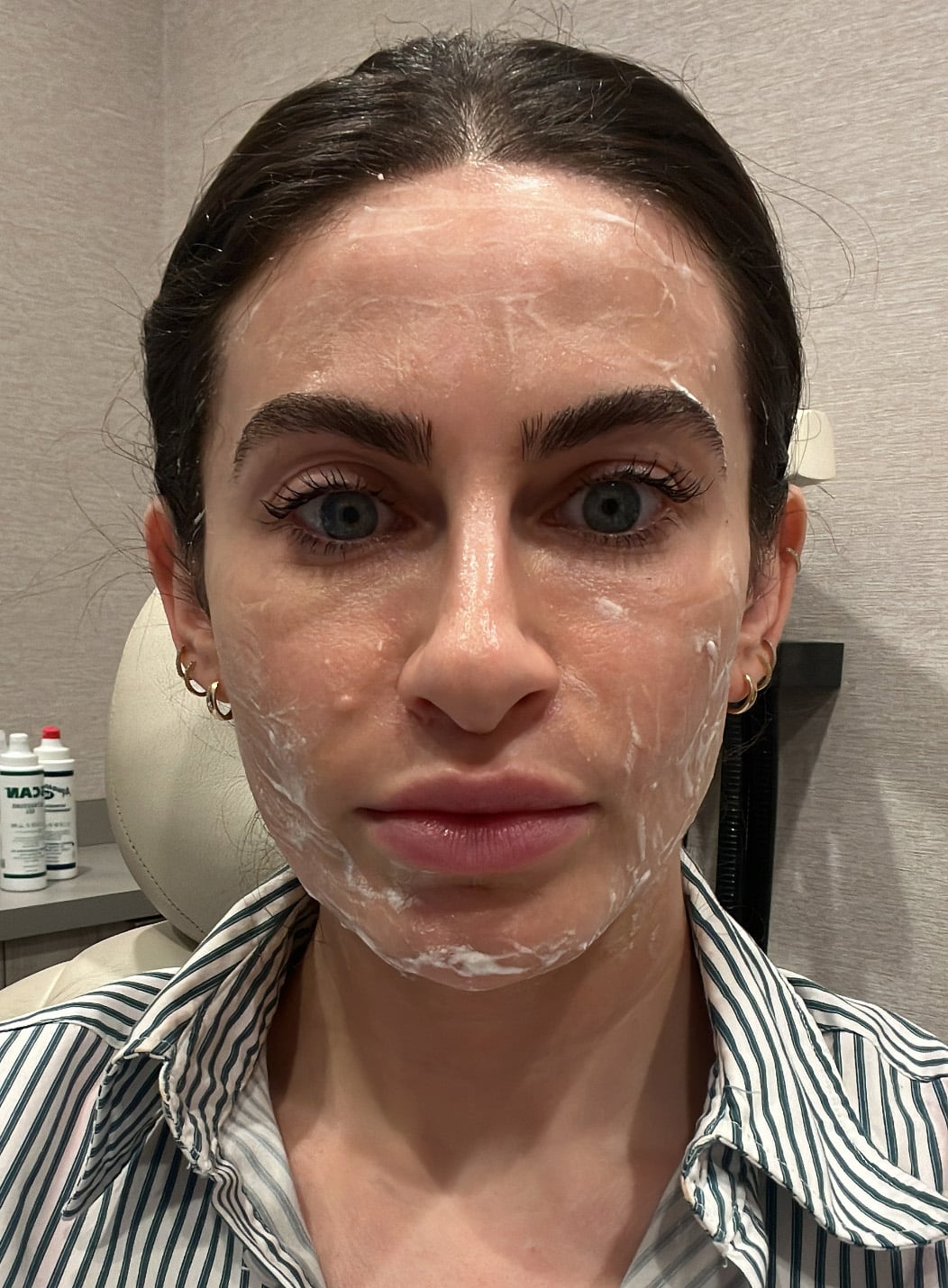 ultherapy before and after