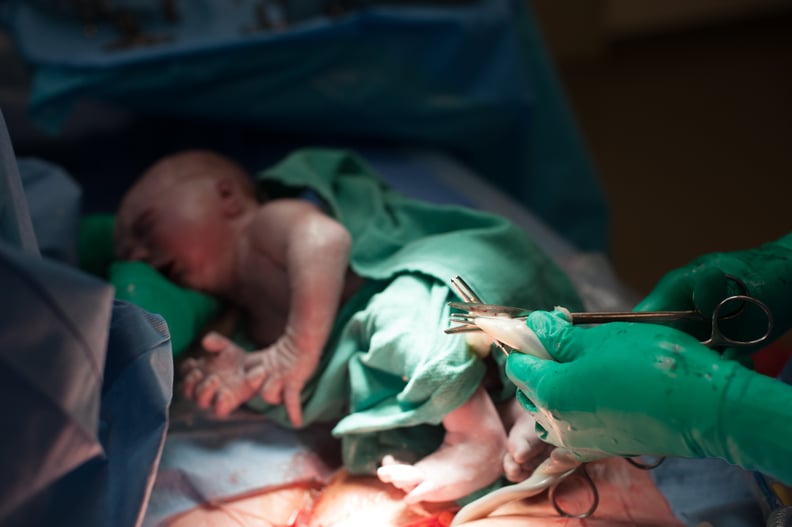 Delayed Cord Clamping for C-Sections