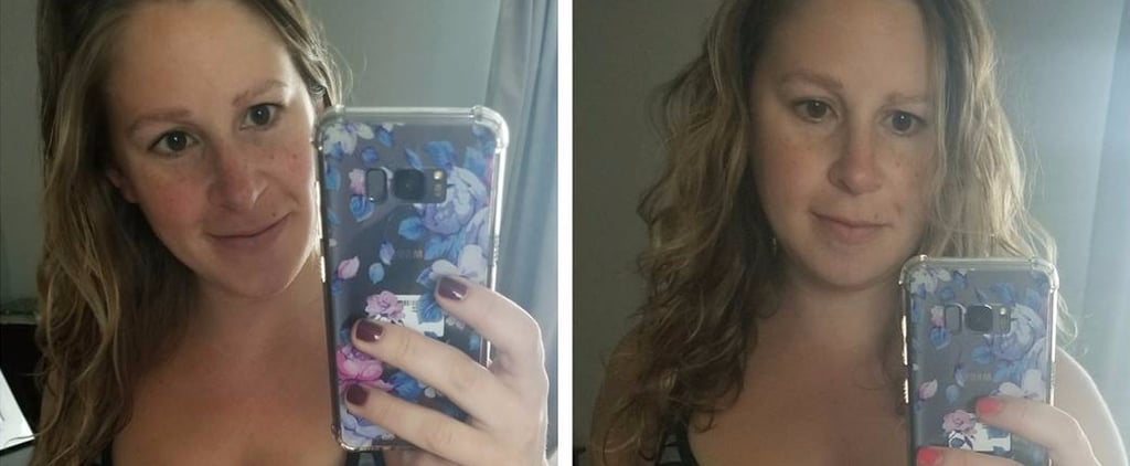 Before and After Pregnancy With Diastasis Recti