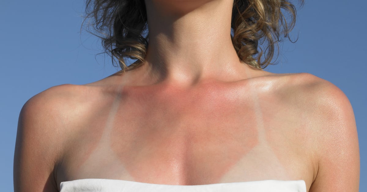 How to Heal a Sunburn ASAP, According to Skin-Care Experts.jpg