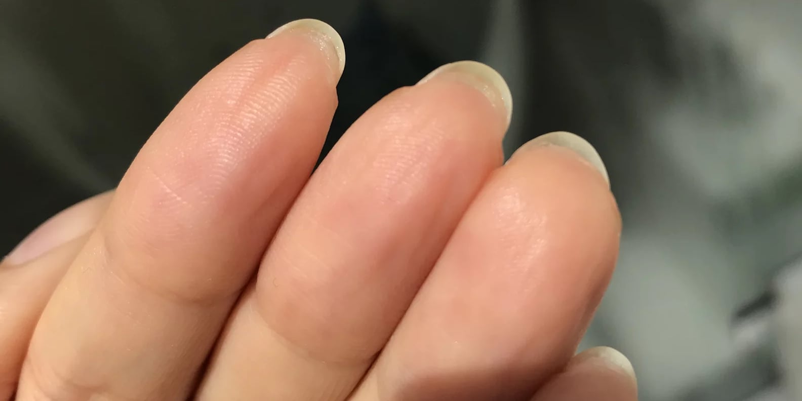 Why You Have Skin Growing Under Your Nails, According to Experts