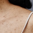 Dermatologists Breakdown Body Acne Causes and Treatments