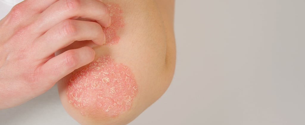Psoriasis Symptoms and Treatments, From Dermatologists