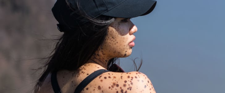 Living With a Skin Condition