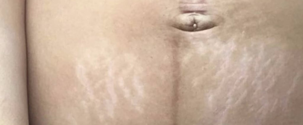Mom Shares C-Section Postpartum Photo