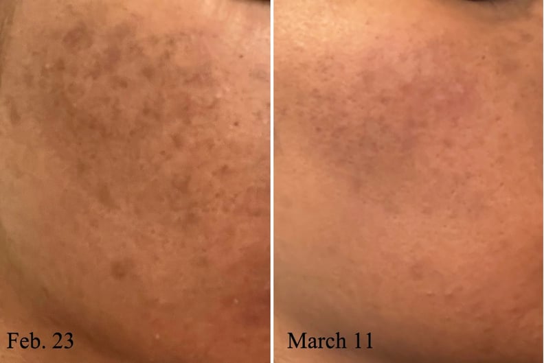 Best Vitamin C Serum on Sale