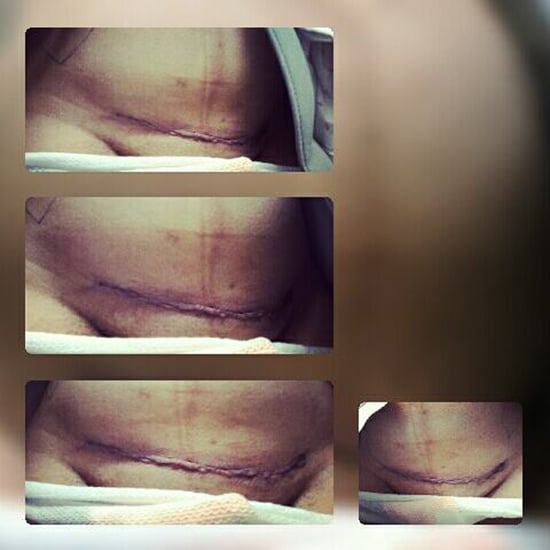 Why This Mom Doesn't Think C-Sections Are the Easy Way Out