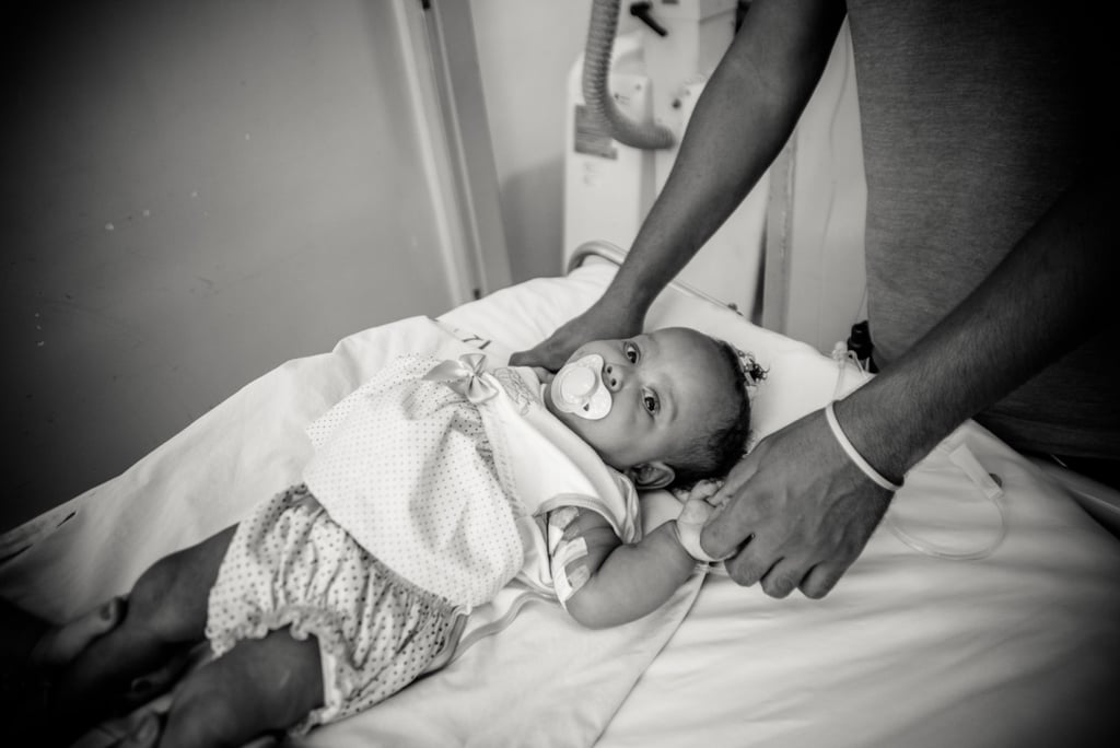 Conjoined Twins Are Separated and Photographed