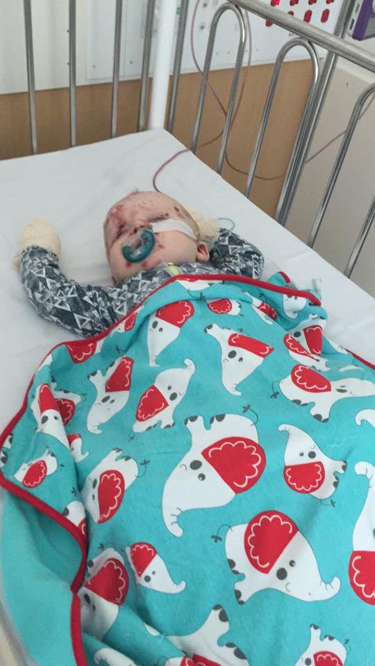 Mom's Plea to Anti-Vaxxers After Baby Gets Chicken Pox