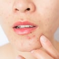 Can Polycystic Ovary Syndrome Cause Acne? We Asked Two Dermatologists to Explain
