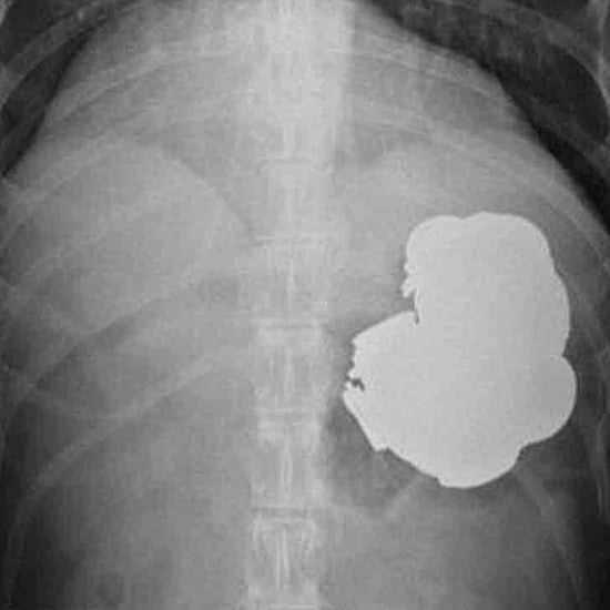 Toddler Has Metal Ball in Stomach After Eating Magnets