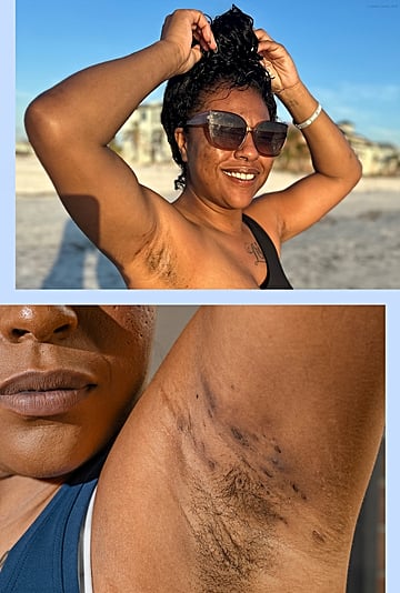 How I Learned to Accept My Hidradenitis Suppurativa