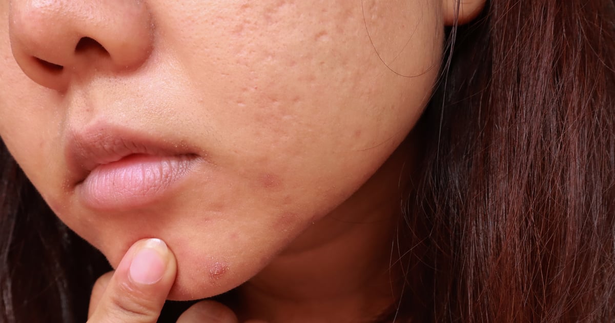 Blackheads Basics: How to Treat and Prevent Them