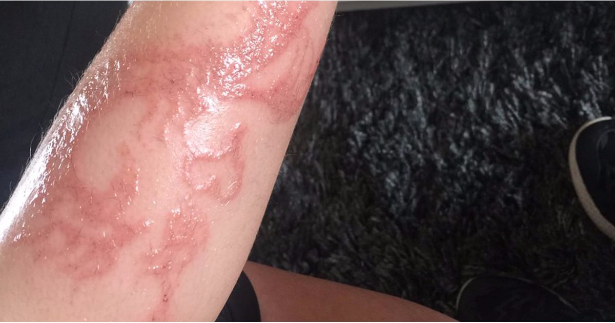 Kid's Allergic Reaction to Henna Tattoo POPSUGAR Family