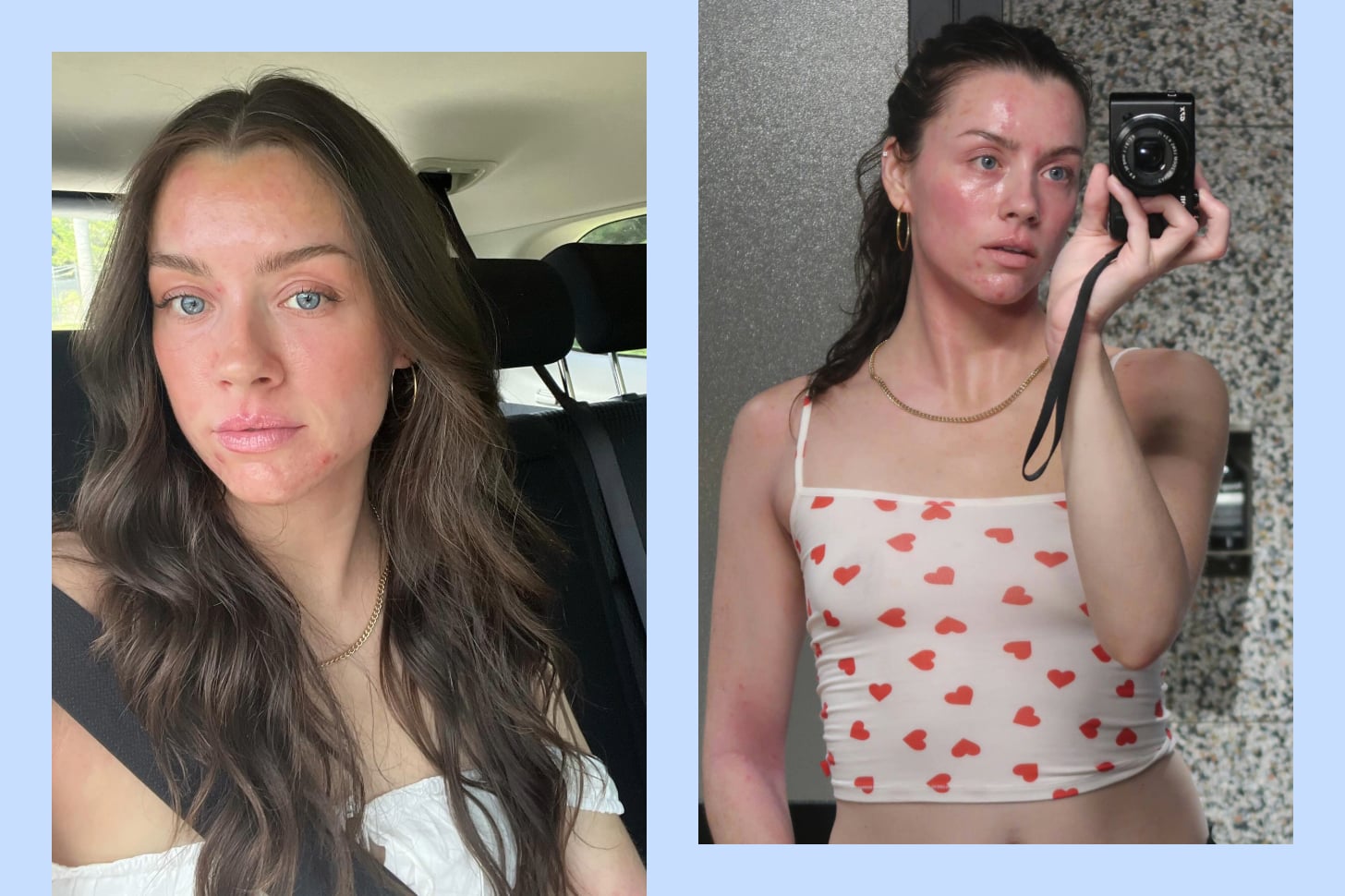 influencer madeleine edwards is shown in side by side photos, both selfies showing her face and skin covered in eczema pathches.