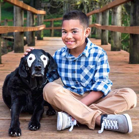 Boy With Vitiligo Meets Dog With Same Condition (Video)