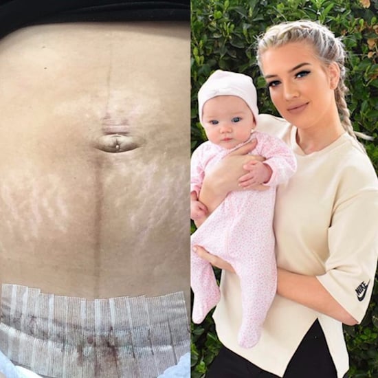 Mom C-Section Photo (Video)