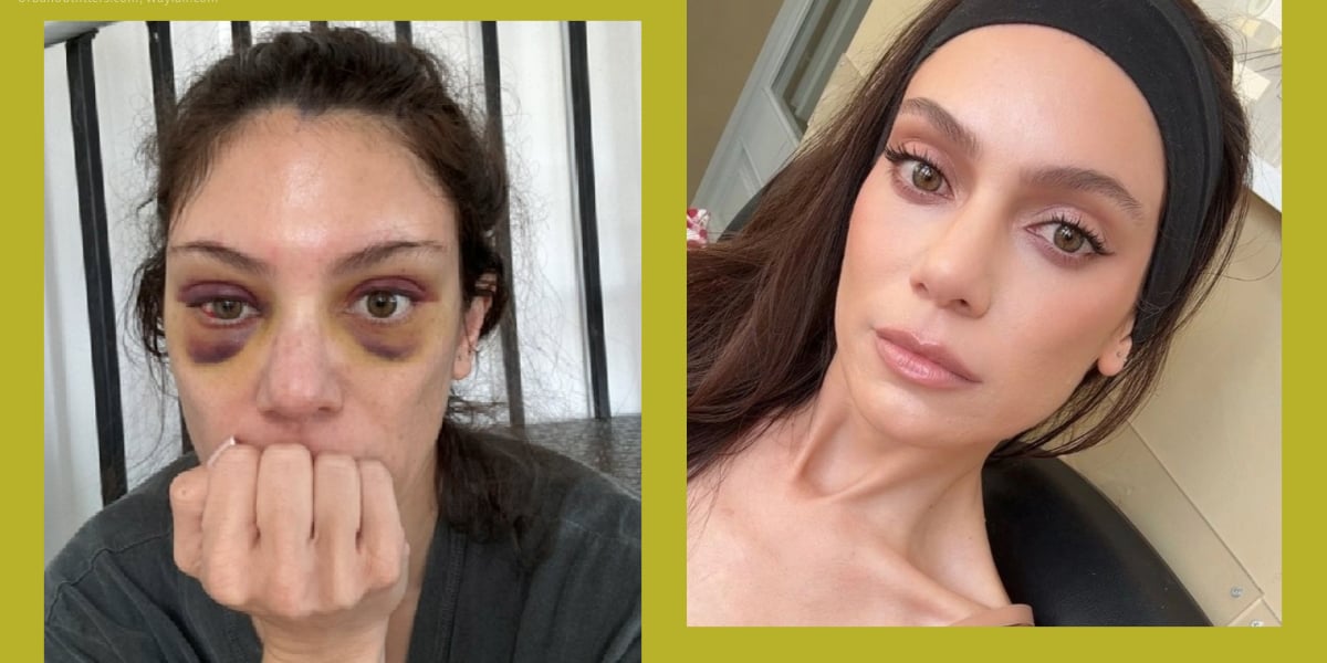 I Got a Celebrity-Beloved "Endo" Brow Lift, and It's Worth the Hype