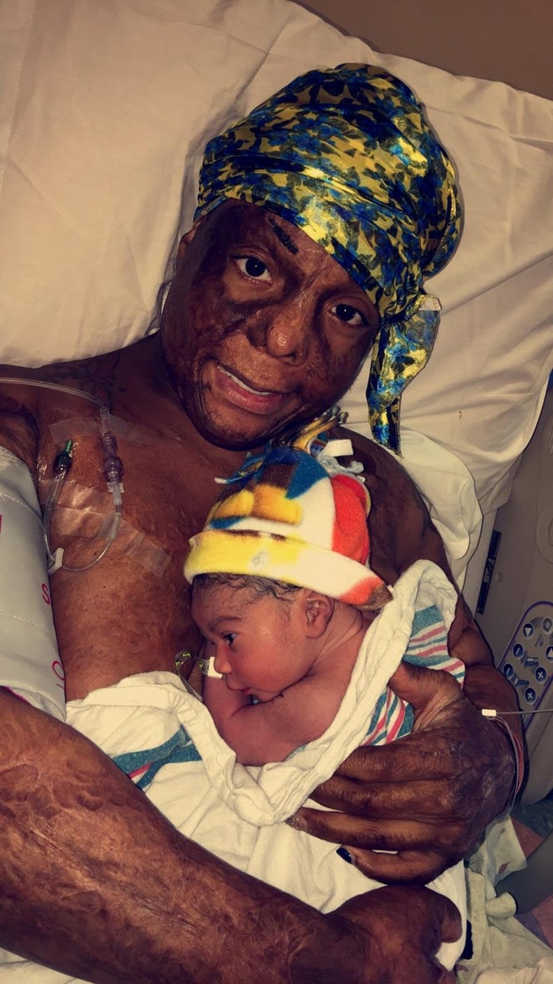 Burn Survivor Breastfeeding POPSUGAR Family