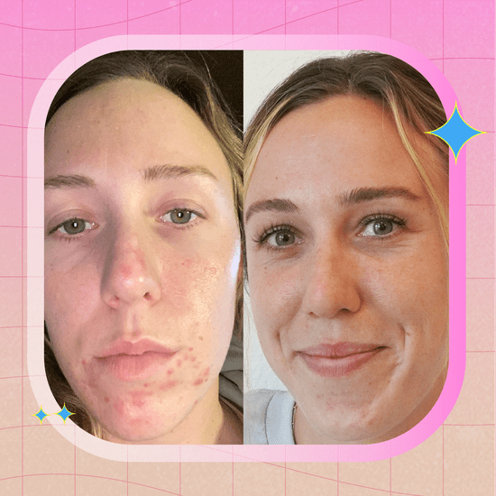 Face Reality Olympic Swimmer Abbey Weitzeil's Acne Story